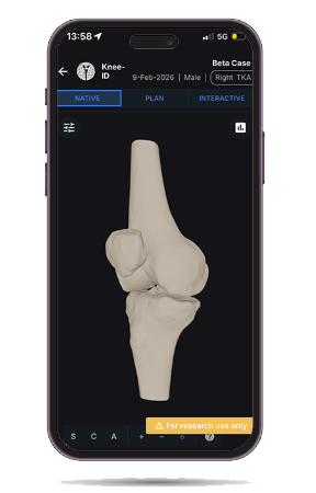 The same plan on a phone, showing the patient's native knee