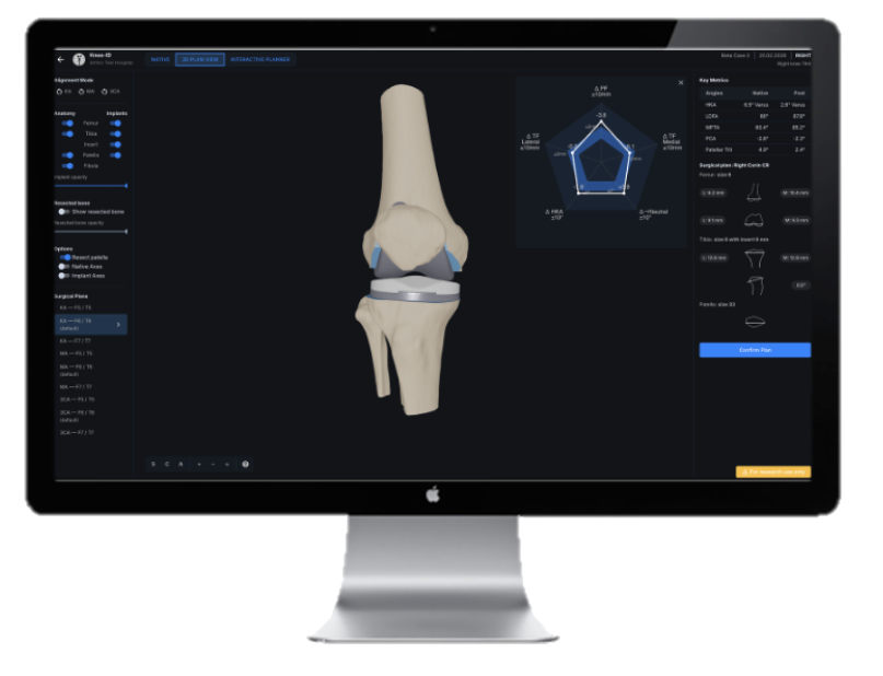 Knee ID on a desktop display: a three-dimensional knee model with
                                      the radial plot, key measurements and implant sizing alongside it